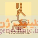 ‏آترزی مری‏ (Esophageal atresia) چیست؟