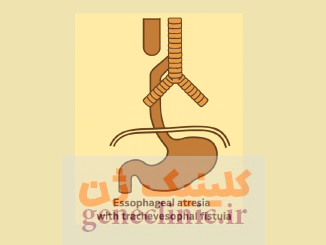 ‏آترزی مری‏ (Esophageal atresia) چیست؟