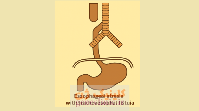 ‏آترزی مری‏ (Esophageal atresia) چیست؟