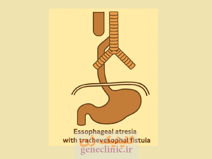 ‏آترزی مری‏ (Esophageal atresia) چیست؟