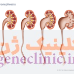 هیدرونفروز‏ (Hydronephrosis) چیست؟