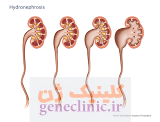 هیدرونفروز‏ (Hydronephrosis) چیست؟