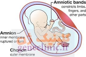 سندرم نوار آمنیوتیک‏ (Amniotic band syndrome) چیست؟