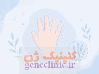 کلینوداکتیلی (Clinodactyly) چیست؟