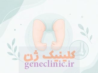 پاچنبری (Clubfoot) چیست؟