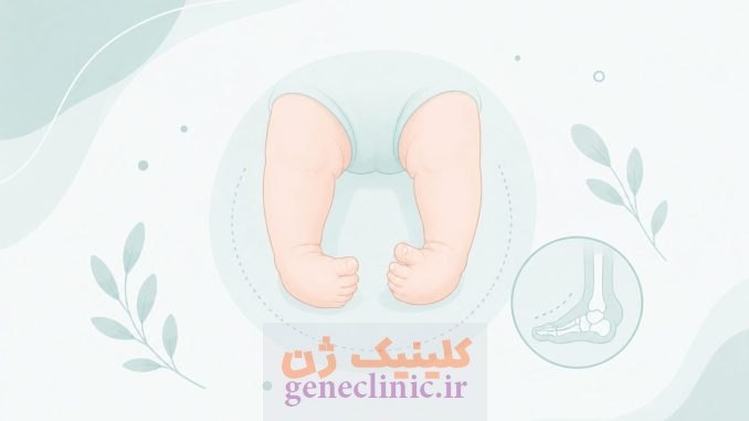 پاچنبری (Clubfoot) چیست؟