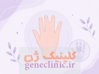 سینداکتیلی یا انگشتان بهم چسبیده (Syndactyly)