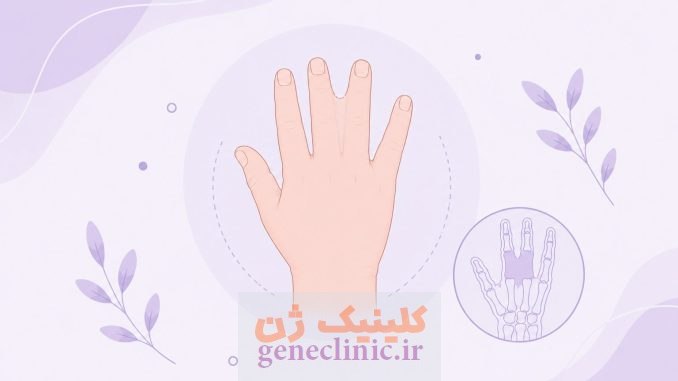 سینداکتیلی یا انگشتان بهم چسبیده (Syndactyly)