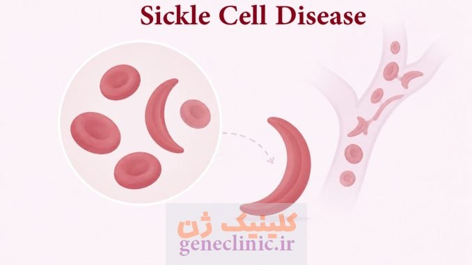 کمخونی داسیشکل (Sickle Cell Disease)چیست؟ کمخونی داسیشکل (Sickle Cell Disease)چیست؟
