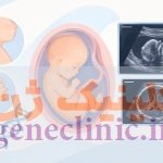 سندرم اسمیت–لملی–اوپیتز (Smith-Lemli-Opitz syndrome) چیست؟